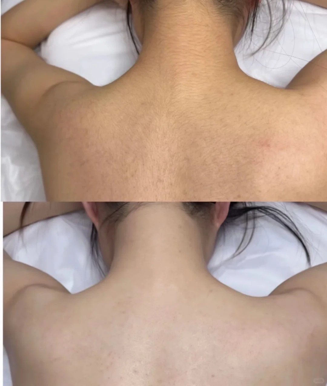 Diolaze treatment areas